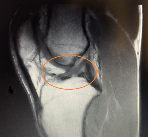 lesione lca elia brocchetti dopo 9 mesi