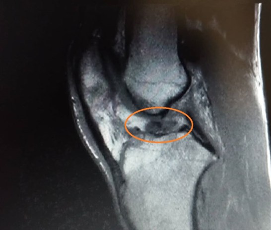 lesione lca elia brocchetti